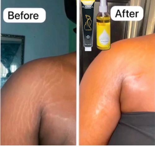 Ahum Stretch Marks 2 Oils, Soap & Sponge Fade Stretch Marks moisturize Naturaly