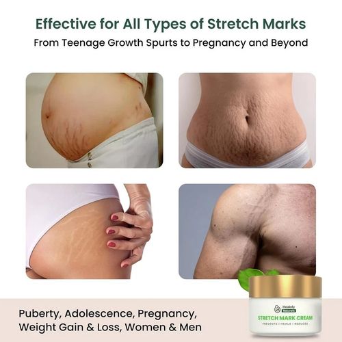Healofy Naturals Stretch Marks Cream For Hydrates Skin 100gm