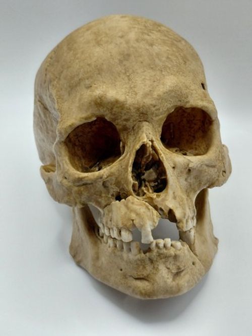 Large Human Skull Replica | Medieval Battle Wound Skull | Resin Anatomical Model