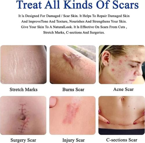 Scar Removal Cream Skin Repair Cream for Old and New Scars Scar Treatment Gel — image 2
