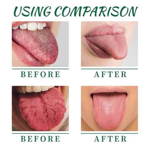 Tongue Repair Spray, Dry Mouth Oral Antibacterial, Instant Relief 1 | UK — image 4