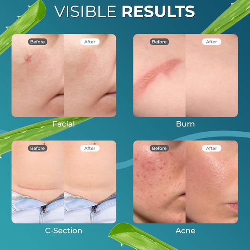 Medical Grade Silicone Scar Tape Aloe Vera 4cm x 1.2M Soft & Discreet — image 9