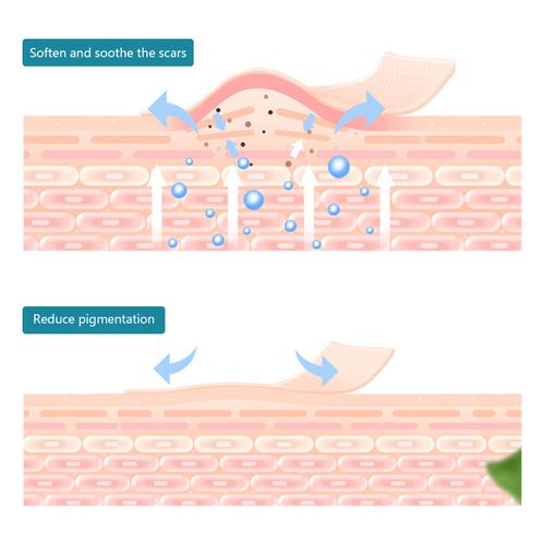 Scars Skin UV Protection Portable Breathable Scar Strips Women Hyperplastic NEW — image 14
