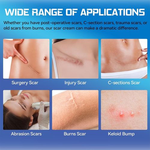Dermatix Ultra Silicone Scar Gel – Advanced Scar Treatment 15gram UK