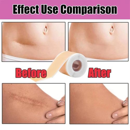 Silicone Scar Sheet MEDICAL GRADE Scar Removal Silicone Tape Treatment