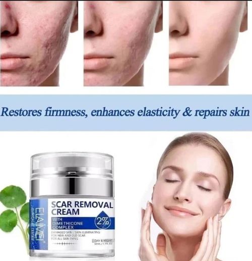 Scar Removal Cream 50ml 2% Dimethicone for Acne Scar Stretch Marks & skin repair — image 4