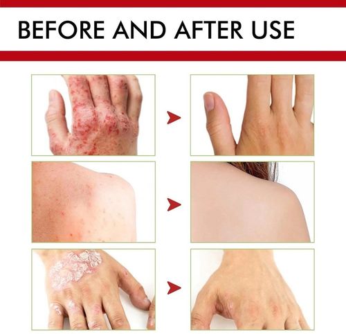 3pcs Antifungal Cream,Cream for Itchy Skin,Antifungal Cream for Skin,Itchy Skin — image 3