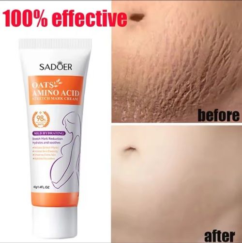 stretch- marks removal cream Skin Repair Pregnancy Belly Spots Removal Cream